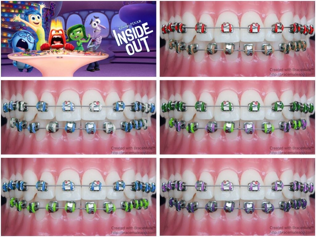 Picture of: insideout #pixar #disney #joy #braces #orthodontist #orthodontics